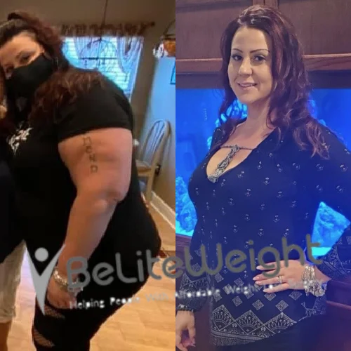 Weight Loss Surgery Gastric Sleeve before and after